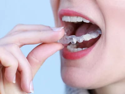 Zahnschienen und ästhetische Zahnheilkunde: Eine perfekte Kombination