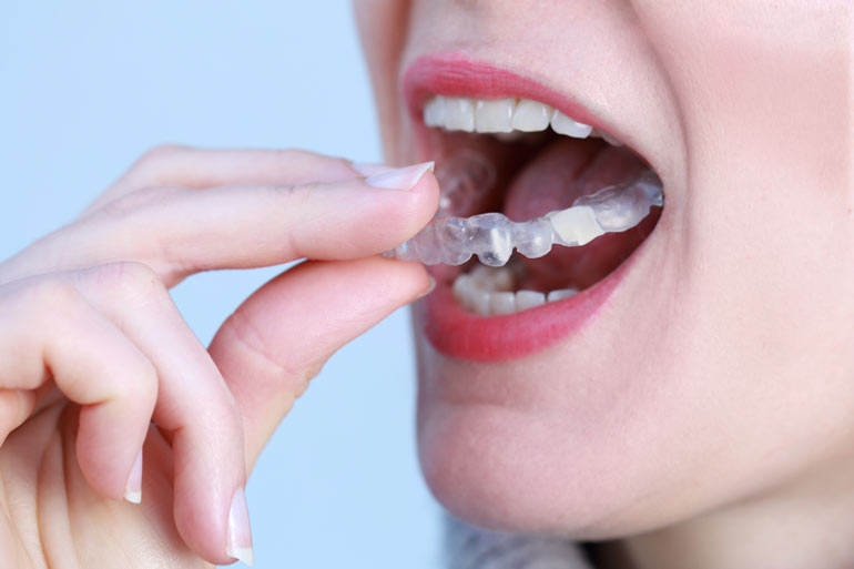 Zahnschienen und ästhetische Zahnheilkunde: Eine perfekte Kombination