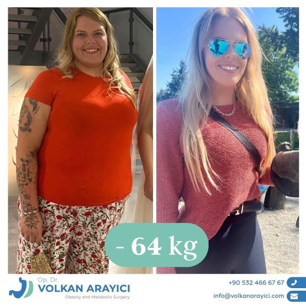 Transparente Informationen: Wie viel kostet eine Magenverkleinerung ohne versteckte Gebühren?